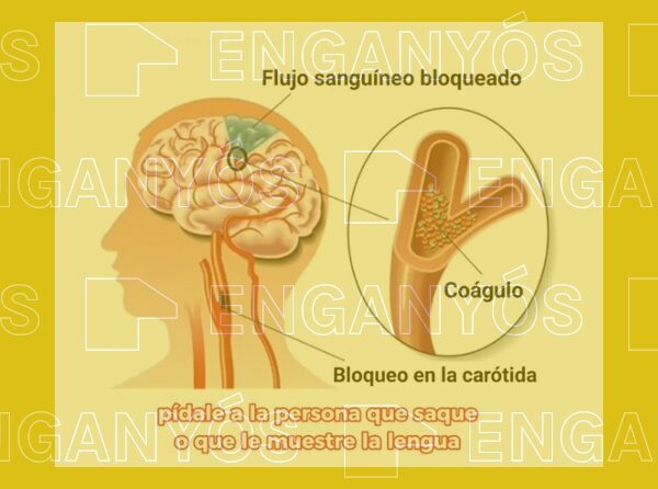 No es cierto que mover la lengua de un lado al otro sea un síntoma unívoco de ictus
